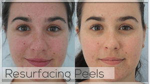Resurfacing Peel Facelove Melbourne
