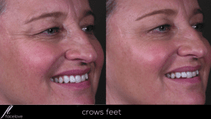 Crows feet anti-wrinkle injection