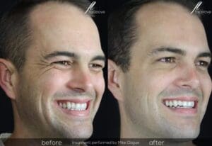 crows feet male treatment before after @ facelove