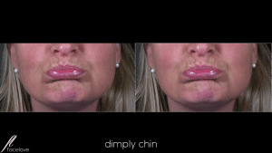 Dimply chin anti-wrinkle treatment