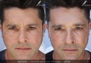 frown line anti wrinkle treatment male before and after facelove