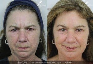 frown lines anti-wrinkle treatment @ facelove