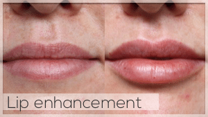 Lip Filler Treatment Facelove Melbourne