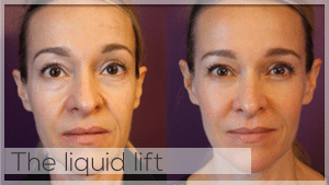 The liquid lift Treatment Facelove Melbourne
