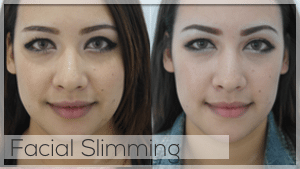 Facial Slimming Treatment at Facelove