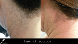 laser hair reduction treatment at facelove