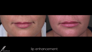 Lip Enhancement Treatment @ facelove