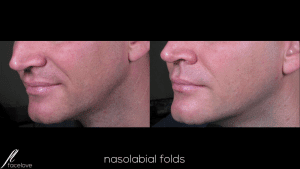 Nasolabial Folds Treatment @ facelove