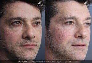 male tear trough before and after treatment facelove