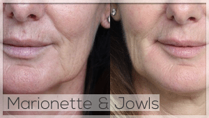 Marionette lines and jowls treatment