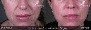 nasolabial filler treatment before and after @ facelove