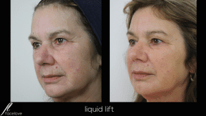 The Liquid Lift Treatment @ facelove