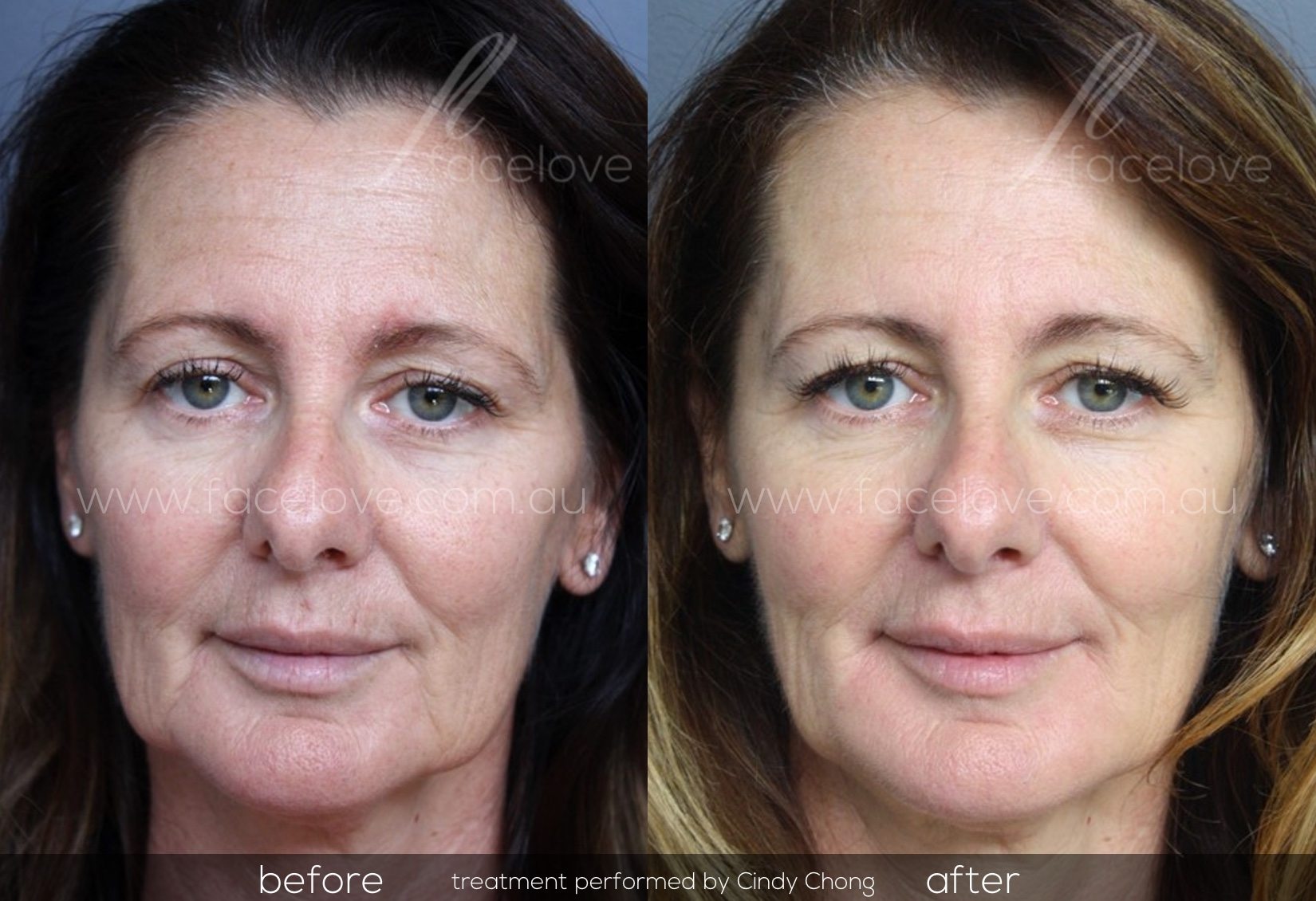 Cosmetic Fillers Florida, Cosmetic Injectables Orlando, NaturalFill FL,  Liquid Facelift Melbourne