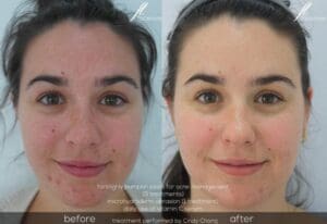 Acne management before and after @ facelove