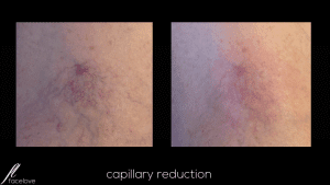 Capillary reduction treatment facelove