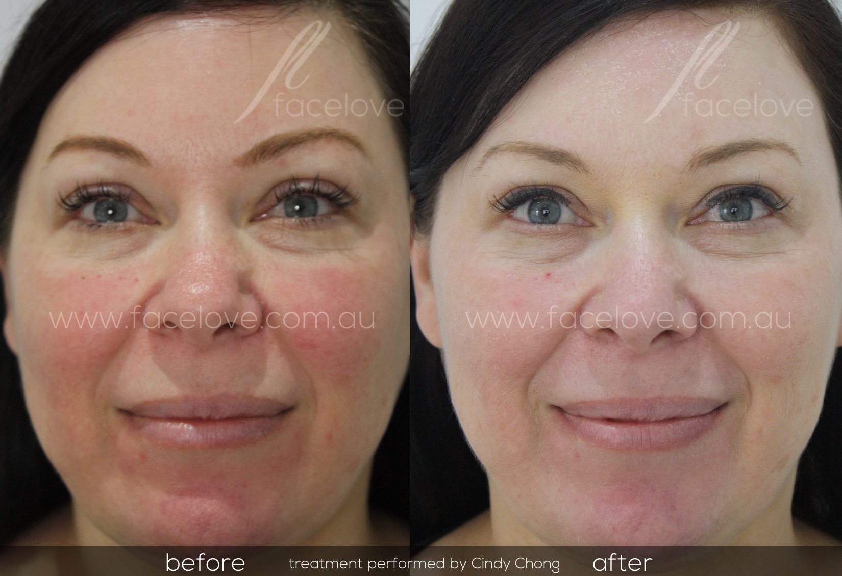 Facial Redness Treatment before and after