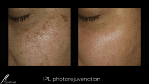 IPL photorejuvenation treatment facelove