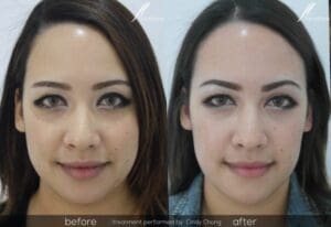 Face Slimming Treatment Before and After