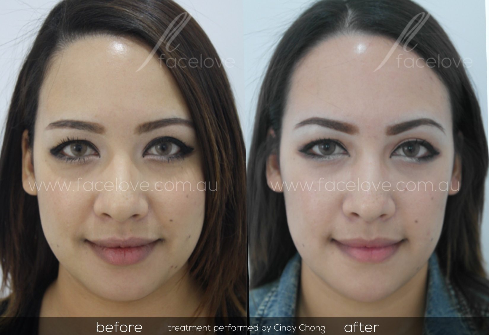 Face Slimming Treatment Before and After Facelove