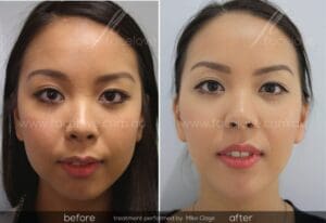 facial reshaping before and after