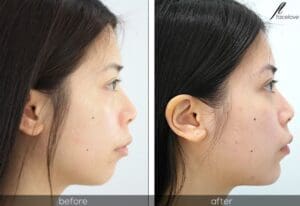 facial reshaping before and after chin augmentation