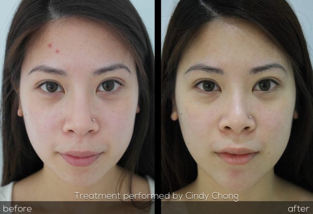 facial reshaping before and after chin augmentation cindy chong