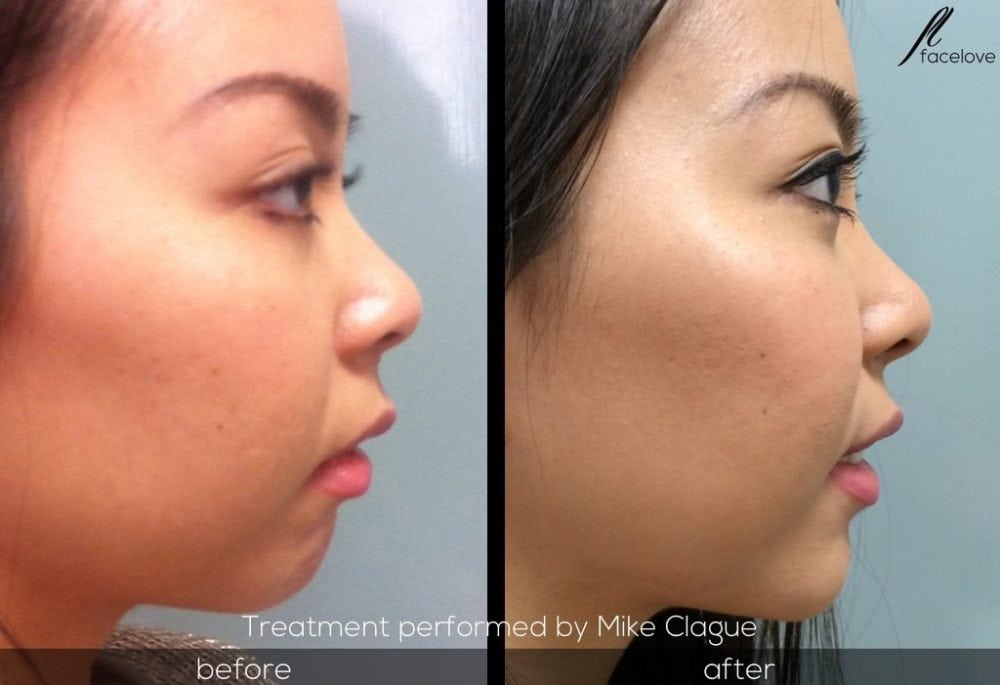 facial reshaping before and after chin augmentation mike clague