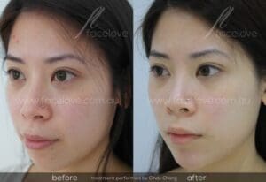 facial reshaping before and after cindy chong facelove