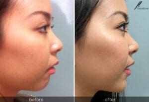 facial reshaping chin before and after