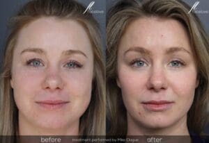 facial reshaping treatment before and after @ facelove