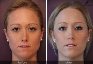 Facial Slimming Before and After at Facelove