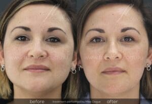 Facial slimming treatment