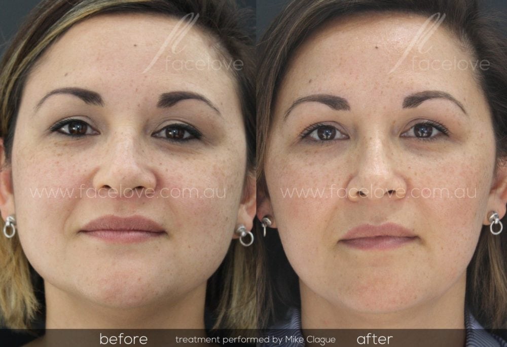 Facial Reshaping and Facial Slimming - Facelove - St Kilda, Melbourne