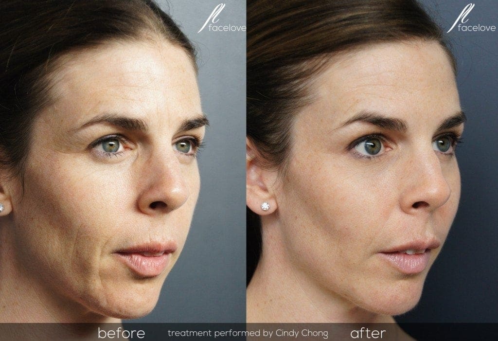 Cheek filler Before and After