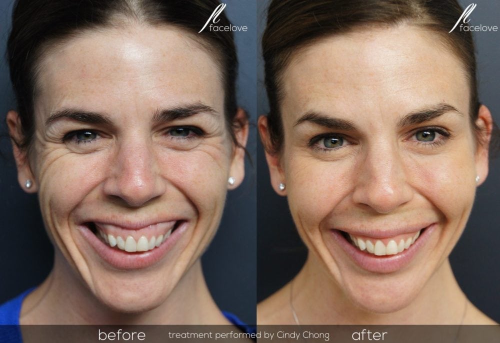 Gummy smile Before and After @ facelove