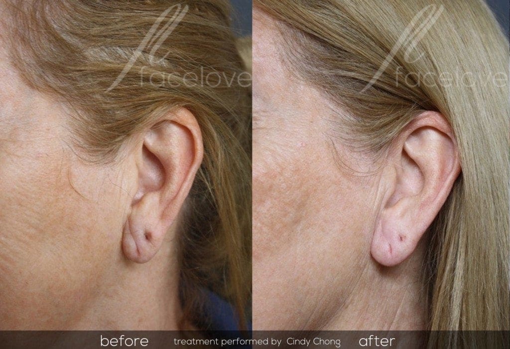 Ear lobe dermal filler treatment before and after