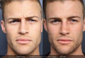 anti-wrinkle injections for men frown lines