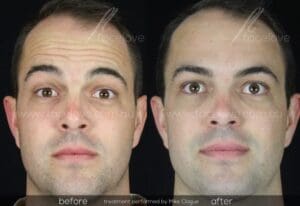 Forehead wrinkle treatment before and after