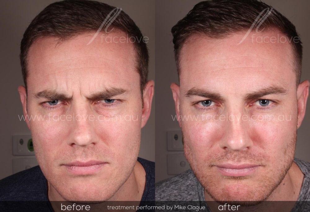 male frown line treatment before and after at facelove