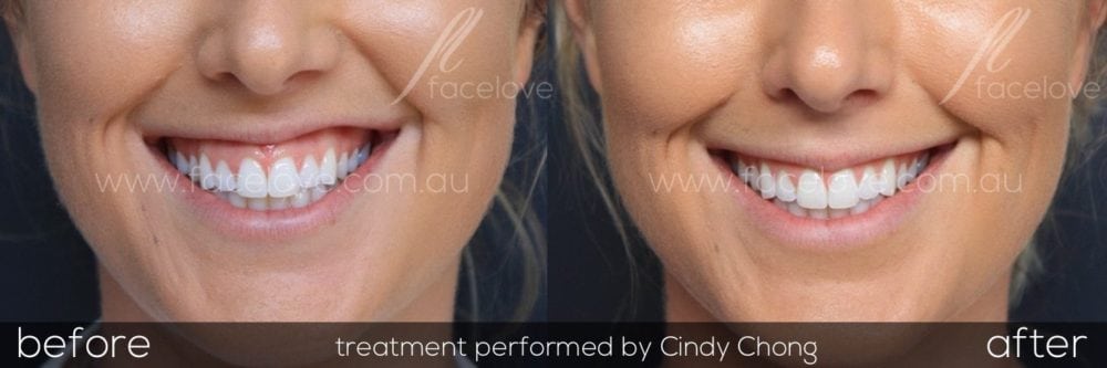Treat a gummy smile with anti-wrinkle injections melbourne