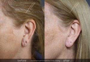 Ear lobe dermal filler treatment before and after