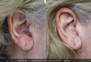 Ear lobe rejuvenation dermal filler treatment before and after