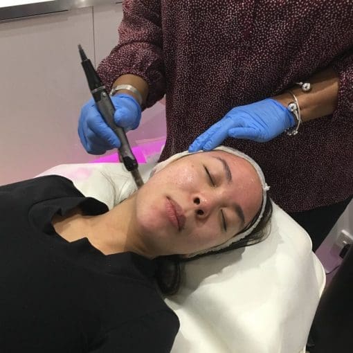 Collagen Induction Therapy Skin Needling