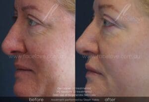 Dermapen before and afters at Facelove Melbourne