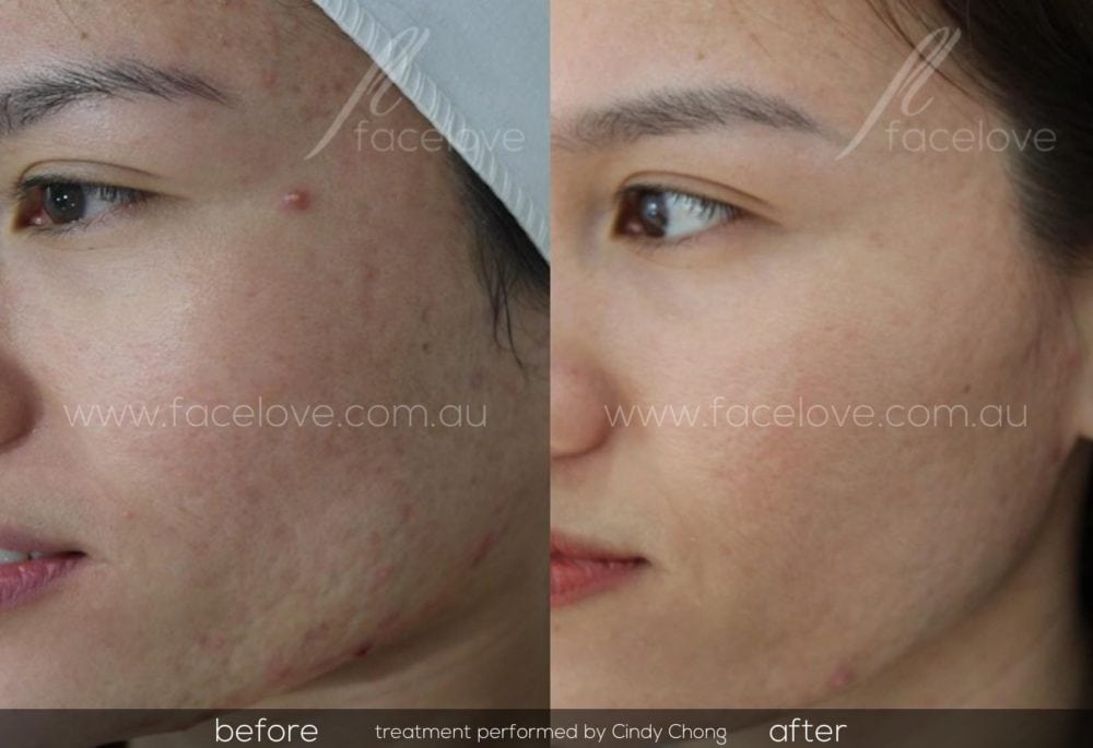 How to get rid of acne scars with Dermapen