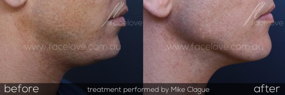 Male double chine fat dissolving injections melbourne