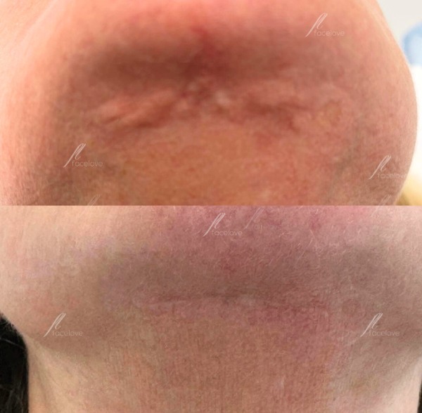 Before and after of chin scar treatment