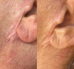 Treatment for facelift scar