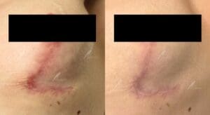 Treating a scar after breast augmentation 
