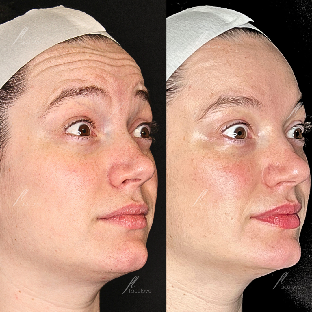 facelove forehead lines anti-wrinkle treatment